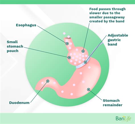 Lap band slippage: Symptoms, How to fix it and more