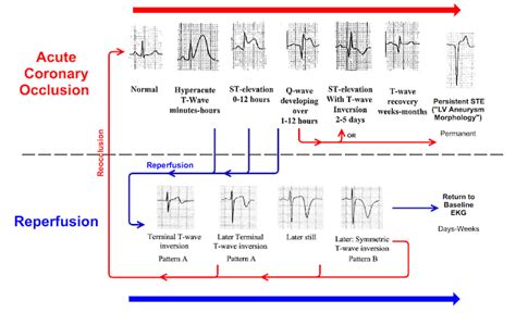 Dr. Smith's ECG Blog: Is there Wellens' syndrome in left bundle branch ...