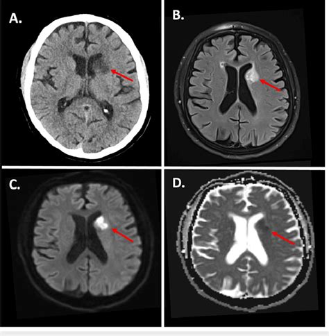 CT and MRI following left caudate nucleus stroke A. CT head showing... | Download Scientific Diagram