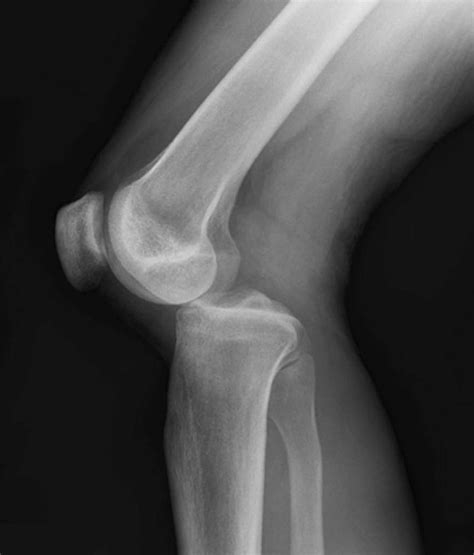 Dislocated Knee – Causes, Symptoms, and Treatment