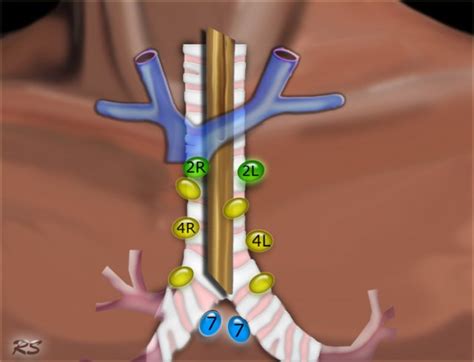 Mediastinal Lymph Nodes