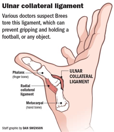 Understanding Drew Brees' thumb injury: What's the UCL? How does the surgery work? | Saints ...