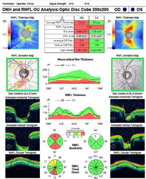 Nerve Fiber Analysis - Glaucoma Associates of Texas