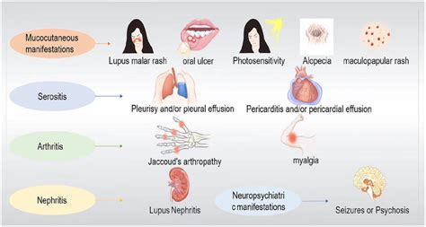 Main clinical manifestations of systemic lupus erythematosus. Systemic... | Download Scientific ...