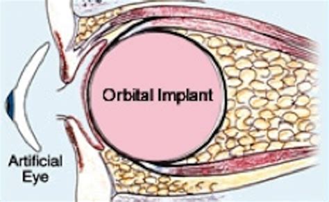 Evisceration / Enucleation (Eye Removal) – Edsel Ing: Eyelid Strabismus ...