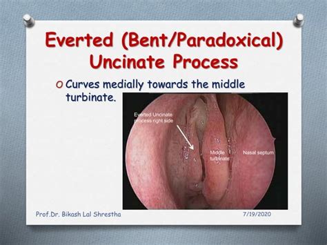 All about uncinate process of nose and paranasal sinuses