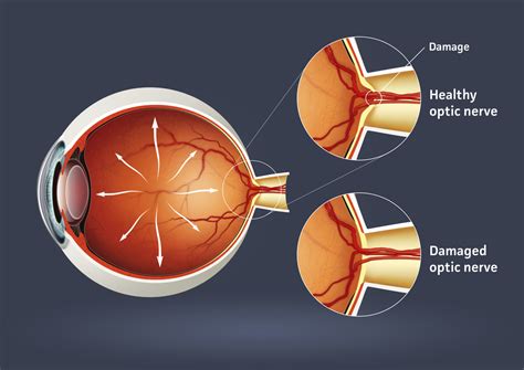 Amaurosis fugax - Things You Didn’t Know