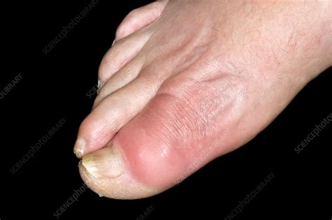 Gout of the big toe - Stock Image - C037/0906 - Science Photo Library