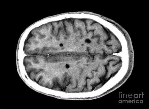 Multiple Sclerosis Brain Lesions Photograph by Scott Camazine - Pixels