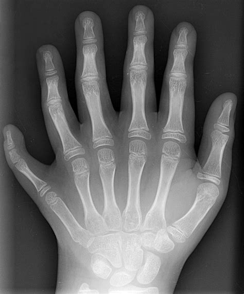File:Polydactyly 01 Lhand AP.jpg - Wikipedia