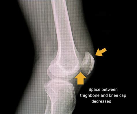 Patellofemoral Arthritis - Regenecare