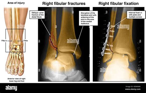 Lateral malleolus fracture hi-res stock photography and images - Alamy