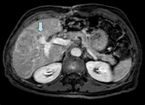 76-year-old male with Gallbladder Varices. TECHNIQUE: 1.5 T MRI of the ...