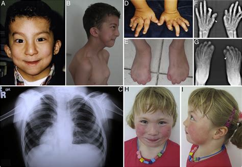 Mutations in multidomain protein MEGF8 identify a Carpenter syndrome ...