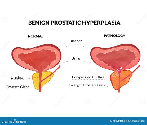 Benign Prostatic Hyperplasia Animation