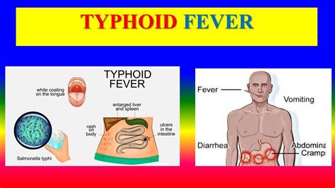 Typhoid Fever: Salmonella Typhi, 47% OFF