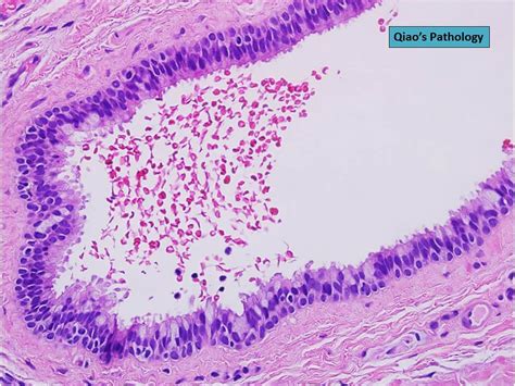 Qiao's Pathology: Branchial Cleft Cyst of the Soft Palate | Flickr