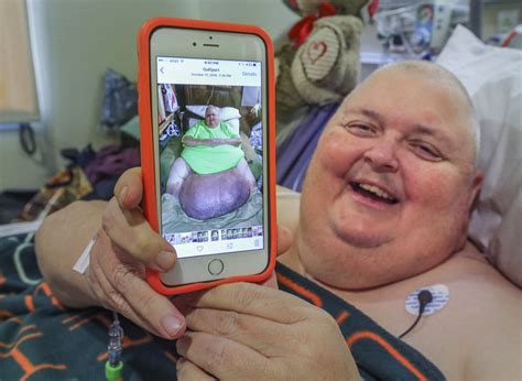 130-pound tumor removed from Mississippi man who was told he was just fat | PennLive.com