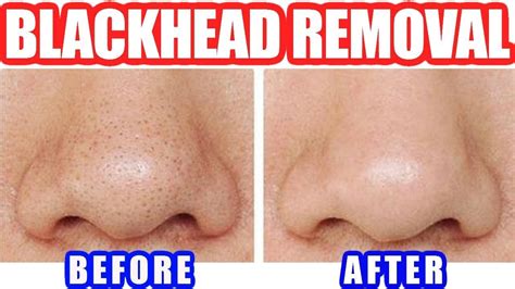 How to Remove Blackheads: Best Blackhead Removal Easy Tool - YouTube