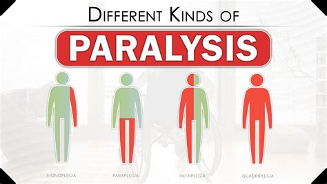 Different Kinds of Paralysis | How Does Someone Become Paralyzed | Types of Paralysis | SRIAAS ...