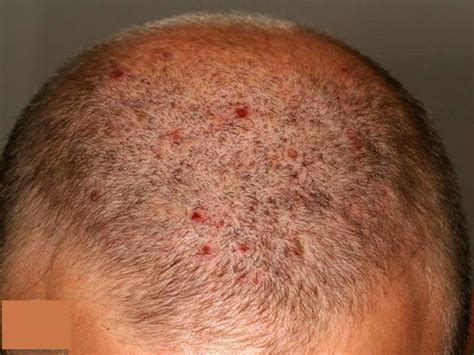 Folliculitis - Causes, Signs, Symptoms, How to Get Rid of Folliculitis