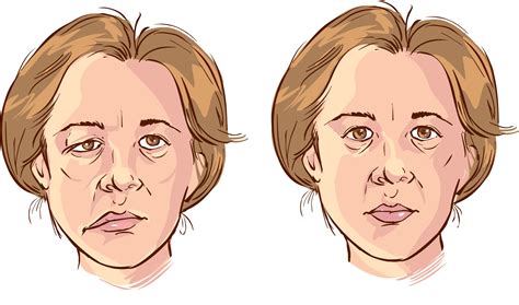 Acupuncture Treatment for Bell’s Palsy - Aligned Modern Health