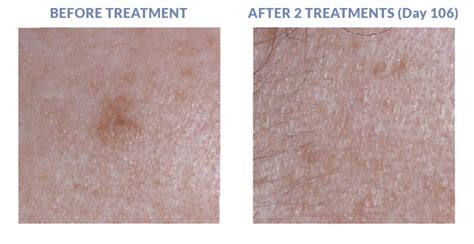 Seborrheic Keratoses | Golden State Dermatology