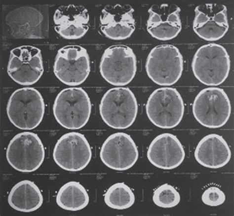 Rescue Measure in Giant Intracranial Meningioma Resection by Tranexamic Acid - Journal of ...