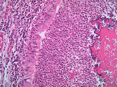 Cystic Fibrosis Histology - Rare Disease Advisor