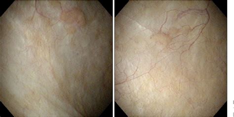 Figure 3 from Malakoplakia in the Urinary Bladder | Semantic Scholar