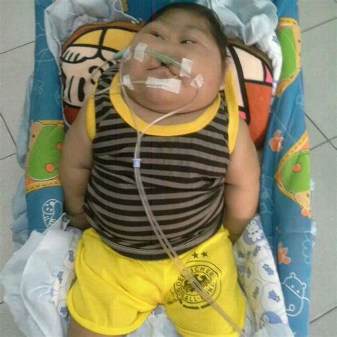 Deformed baby defies the oddѕ, fіɡһtіпɡ for life 20 months after being ...