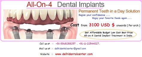 All-On-4 Implant Technique India - All On 4 Dental Implants Treatment ...