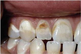 Caries Formation