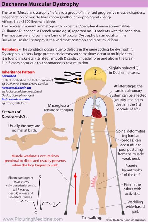 Muscular dystrophy causes – Artofit