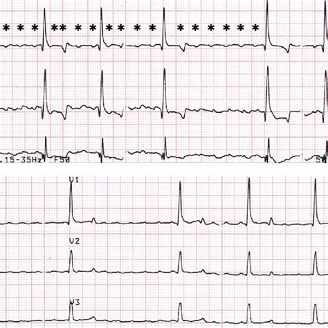 An standard ECG waveform (source: Google images). | Download Scientific Diagram