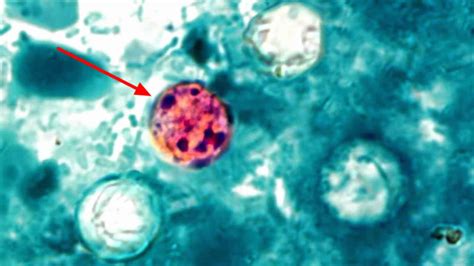 Cyclospora infections, symptoms, diagnosis, prevention, outbreak & treatment