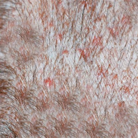 12 Pictures of Folliculitis in Dogs With Veterinarian Info