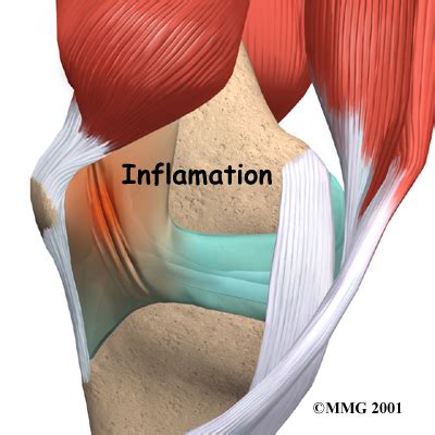 Physical Therapy in Columbia for Knee Pain - Plica Syndrome