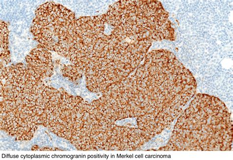 Pathology Outlines - Merkel cell carcinoma