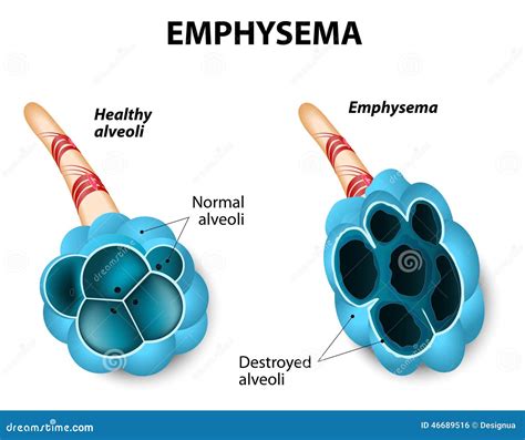 Emphysema Stock Vector - Image: 46689516