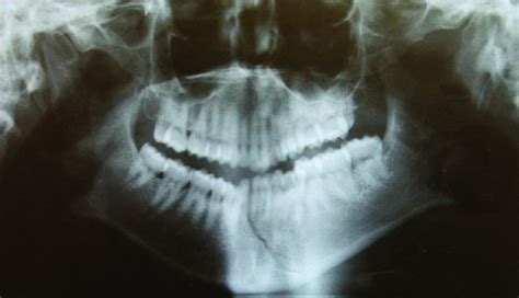 13: Mandibular Fractures | Pocket Dentistry