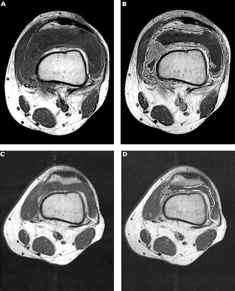 Quantitative magnetic resonance imaging as marker of synovial membrane regeneration and ...