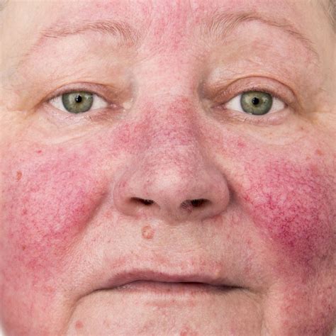 Rosacea – Entstehung und Behandlung - Beauty Guide