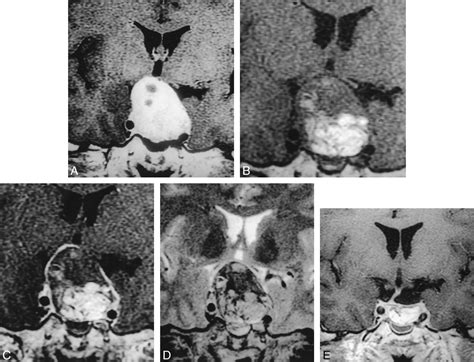 Pituitary Adenomas: Early Postoperative MR Imaging After Transsphenoidal Resection | American ...