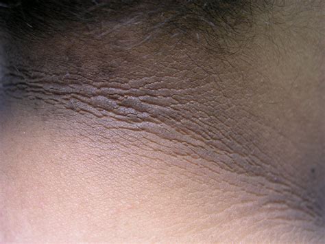 Acanthosis nigricans - Dermatology Advisor