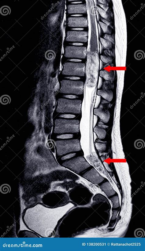 MRI Lumbar Spine IMPRESSION:Intra-dural Extramedullary Mass at Distal Cord and Conus Medullaris ...