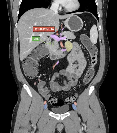 How to read a CT of the abdomen and pelvis | Image | Radiopaedia.org