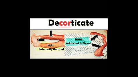 decorticate vs decerebrate posturing - YouTube