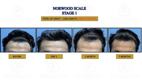 Norwood 1 | Hair Transplant Centre Philippines