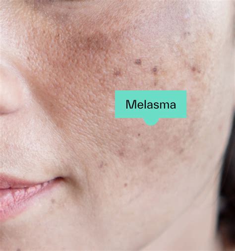 Melasma Treatments - How To Treat Melasma - Dermatica